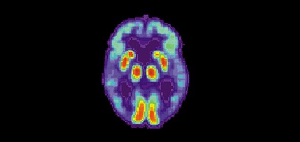 Картина ПЭТ-сканирования мозга пациента с болезнью Альйгеймера. Изображение phys.org.
