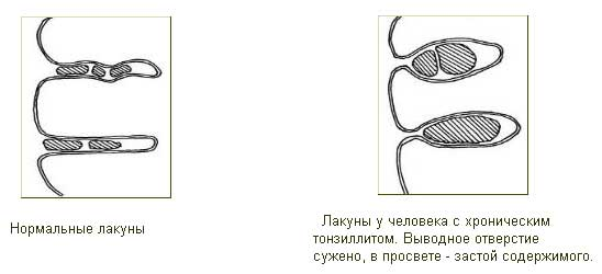 Лакуны: их классификация и способы заполнения. Анализ лакун в лингвистике