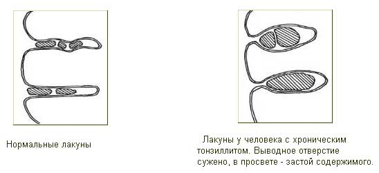 Как лечить гнойную ангину?