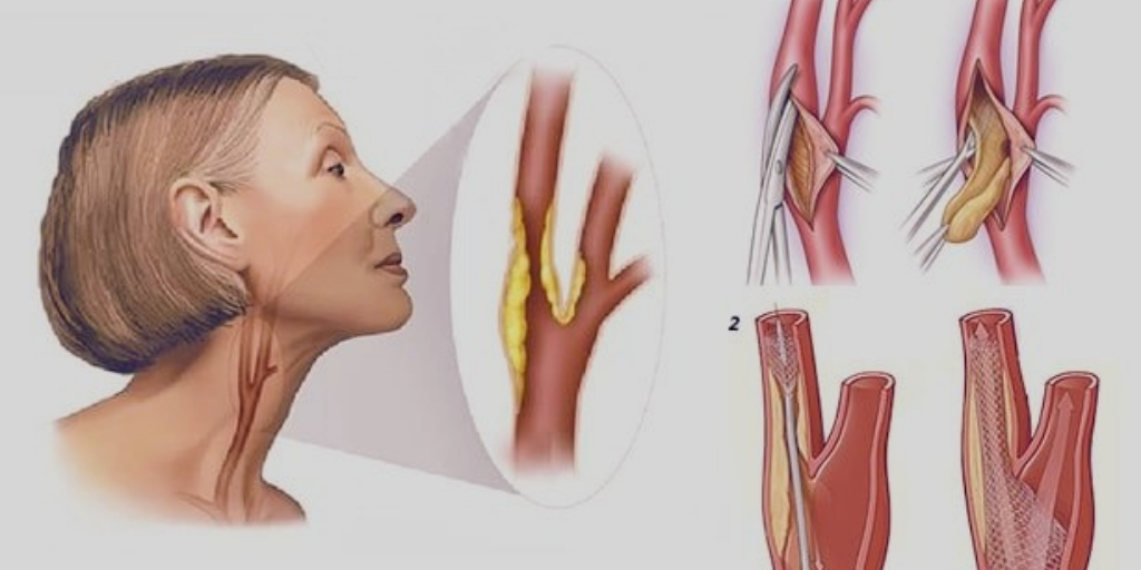 Атеросклероз бляшка сонной артерии. Сосудов атеросклероз сосудов шеи. Атеросклероз сосудов шеи сонных артерий. Субтотальный стеноз сонной артерии. Бляшка на шее операция