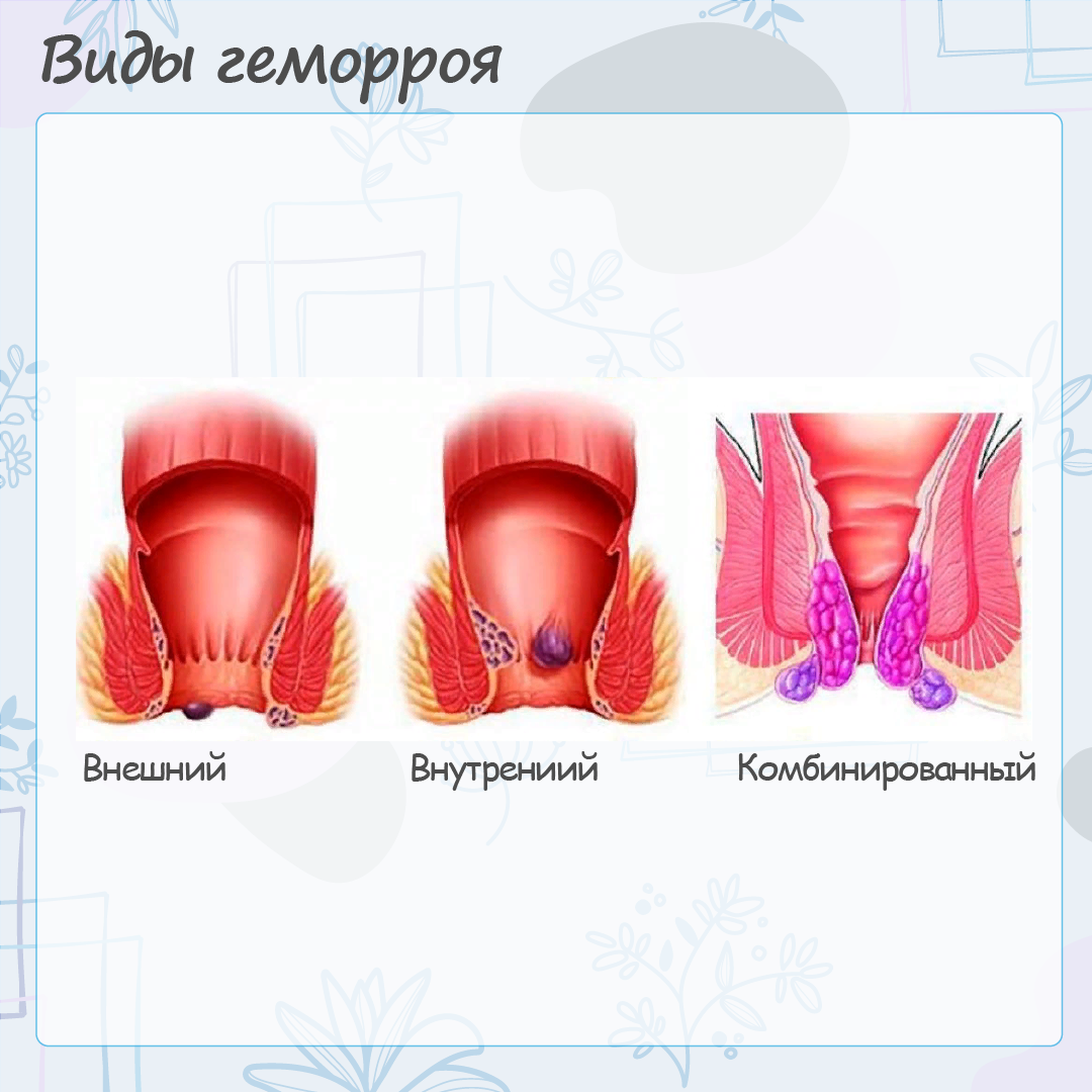 Послеродовой геморрой