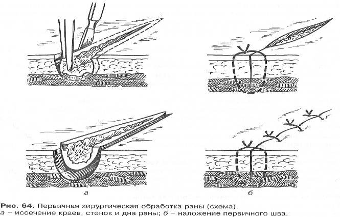 Чем можно обрабатывать швы после операции. Первичная хирургическая обработка (Пхо). Первичная хирургическая обработка гнойной раны. Первичной хирургической обработке непроникающих РАН.