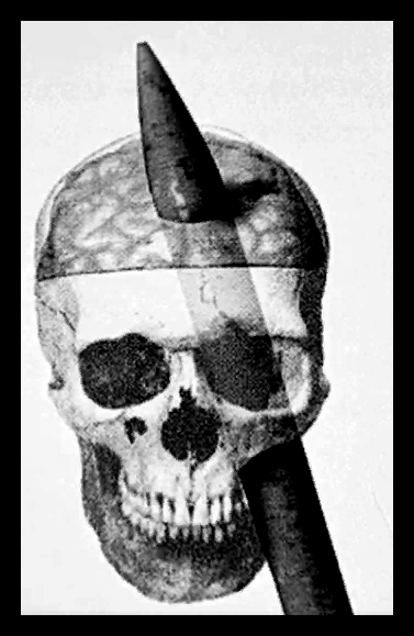 Травма, полученная Ф.Гейджом.