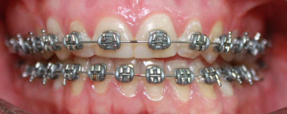 Лигатурная система