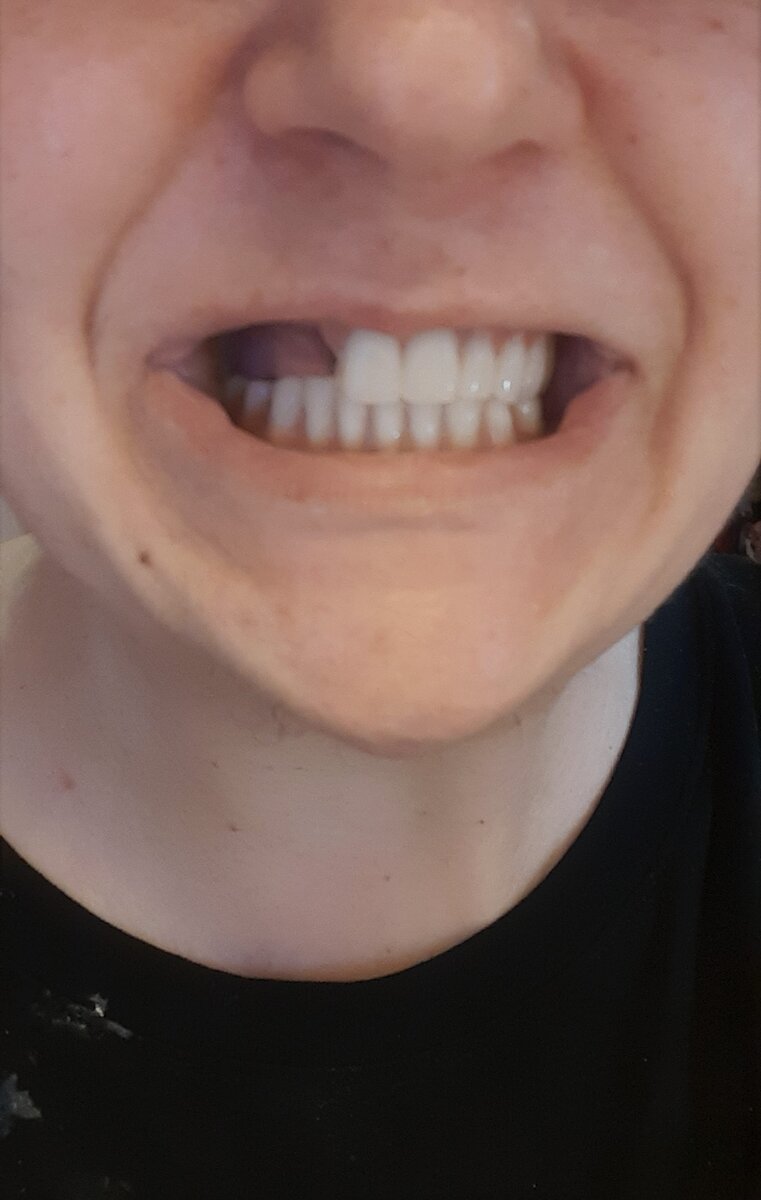 бесконечно отваливающиеся и ломающиеся протезы от клиники Аттика на пр. Королева в Санкт-Петербурге