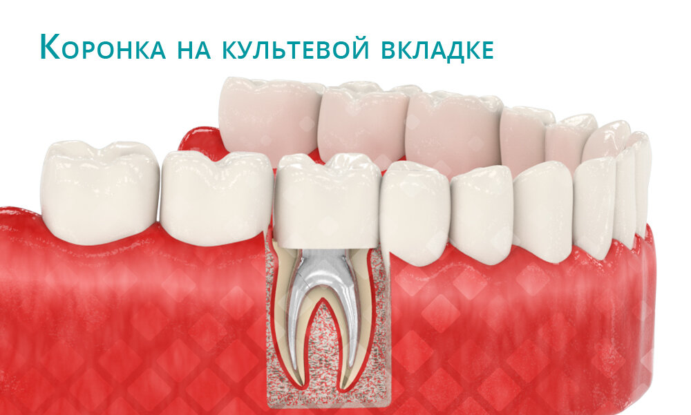 А вот культевая вкладка – уже более выигрышный вариант. Фото: Smile-at-Once.ru.