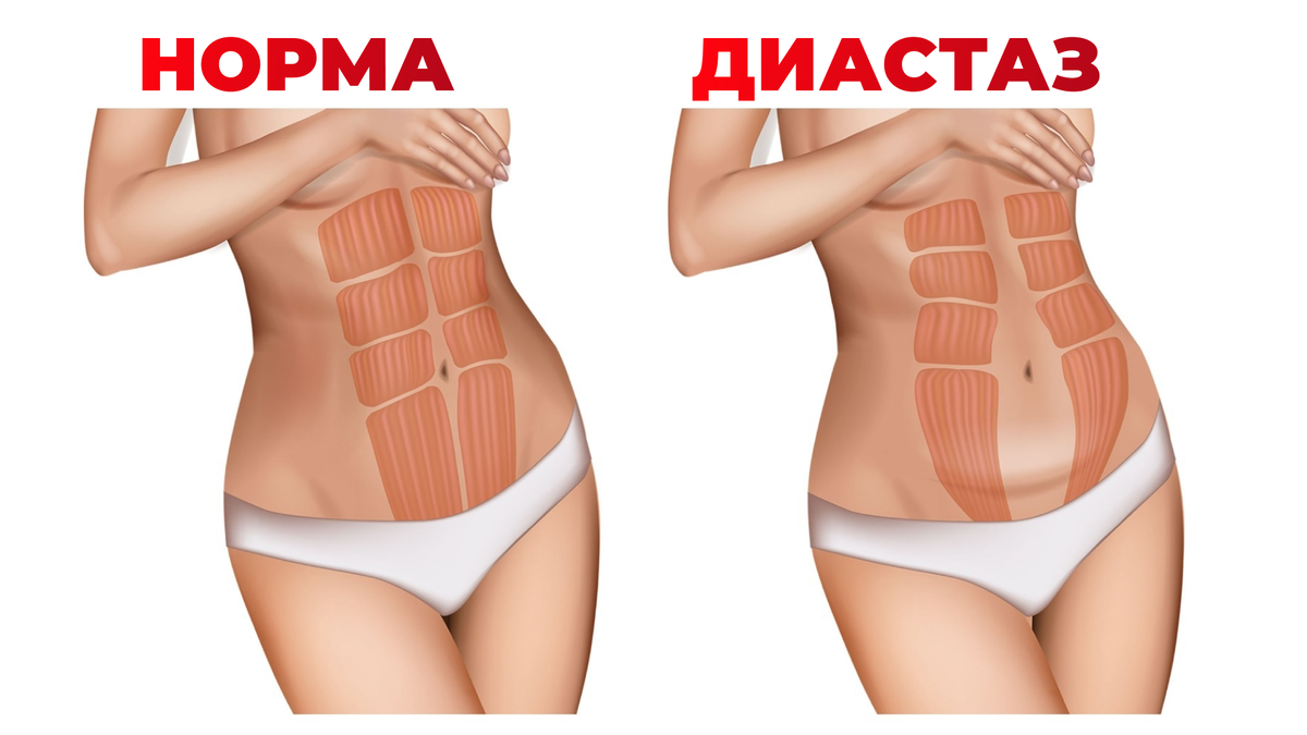 Брюшная стенка у женщин. Диастаз прямой мышцы живота. Диастаз брюшной стенки. Брюшной диастаз после родов.