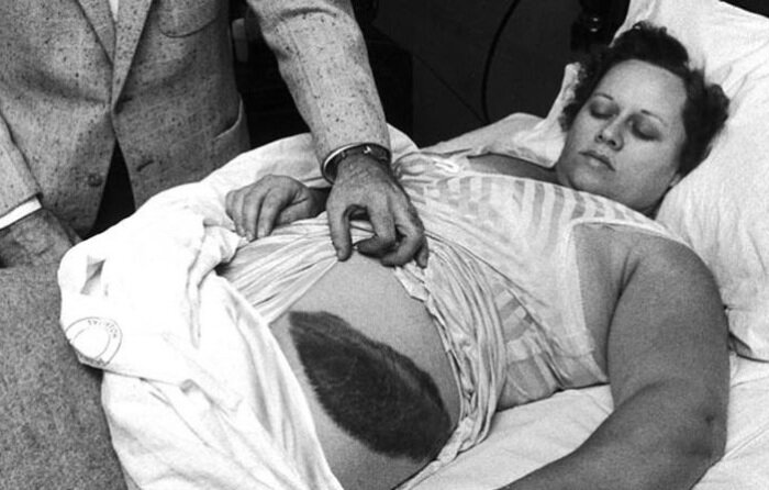 Метеорит оставил на теле Энн Ходжес огромный ожог. | Фото: animalworld.com.ua