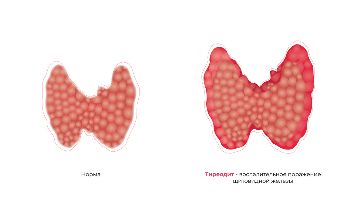 Как выглядит щитовидная железа при аутоиммунном тиреоидите 