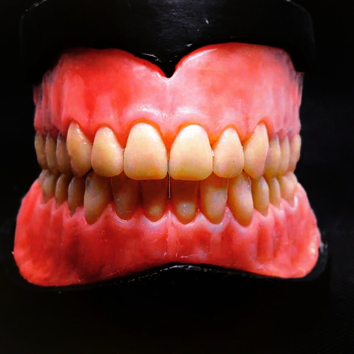 #dental #бюгельныйпротез#съемноепротезирование #протезнабалке#dentalphotography 