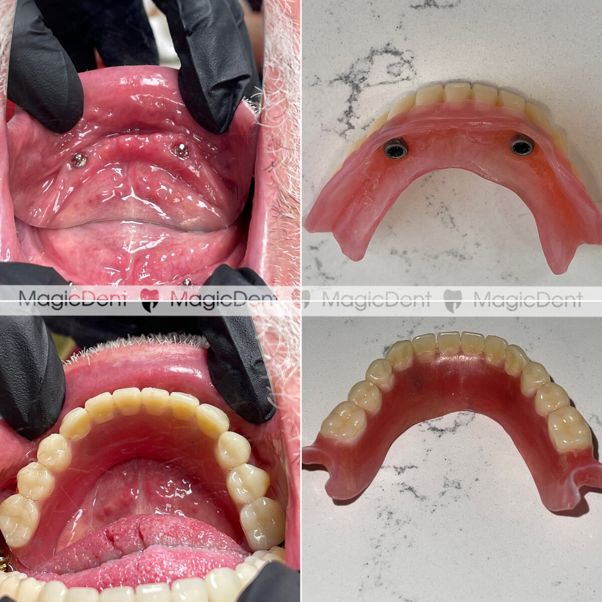 Установка условно-съемного протеза на нижнюю челюсть.
