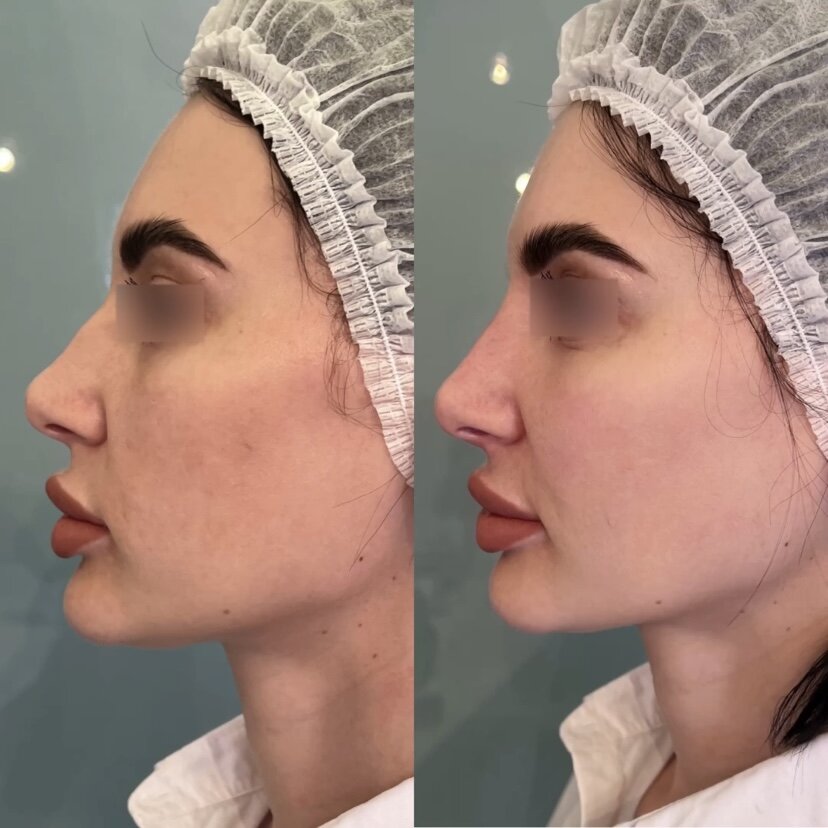 Результат безоперационной ринопластики До и сразу После процедуры