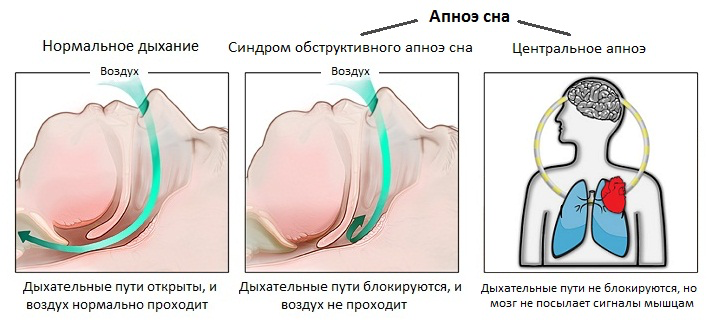 Виды остановки дыхания. Синдром обструктивного апноэ сна у детей. Синдром центрального апноэ. Синдром центрального ночного апноэ. Причины остановки дыхания у детей.