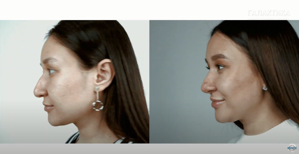 До и после операции