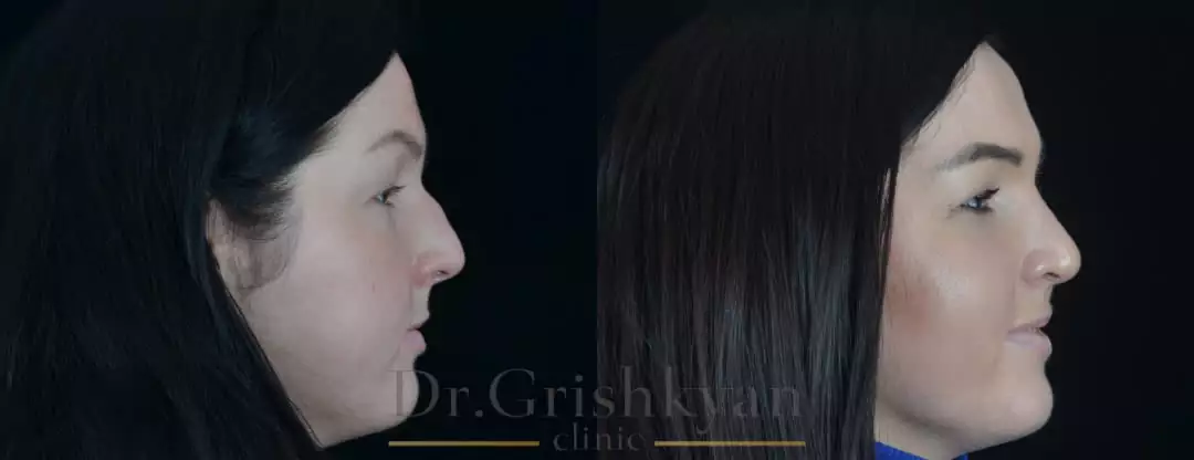 Ринопластика и исправление дыхания фото до и после. Фото с сайта Д.Р. Гришкяна. Имеются противопоказания, требуется консультация специалиста