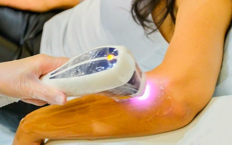 Метод эпиляции лазерным лучом