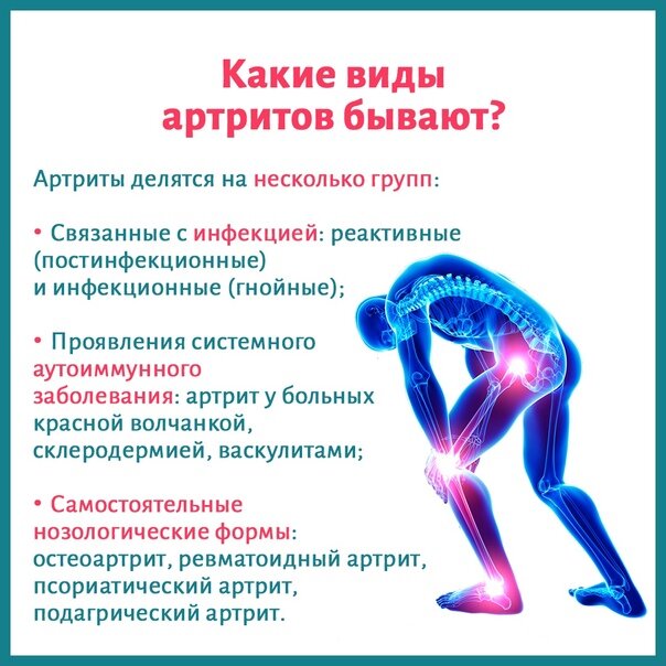 коротко об артритах