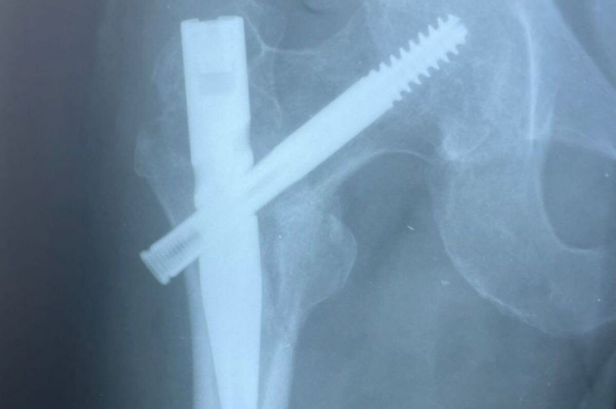    Пятигорские врачи помогли пациенту с не зараставшим переломом бедра