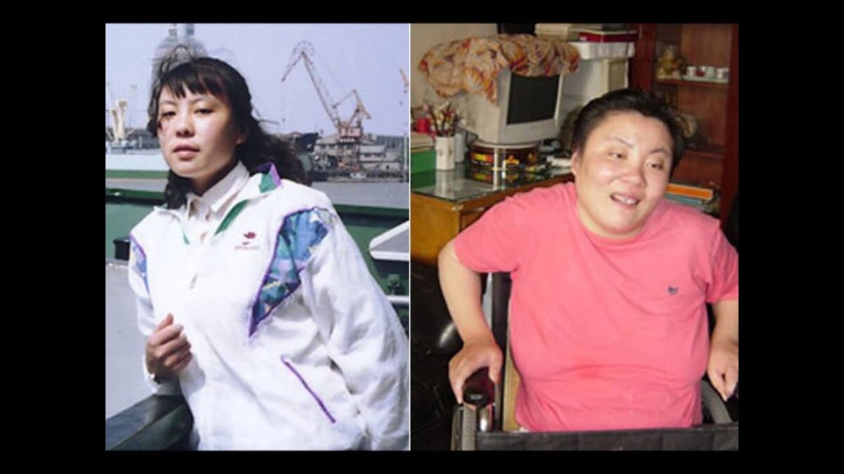 Отравление талии. Таллий металл. Чжу линь болезнь. Таллий. Отравление талии.