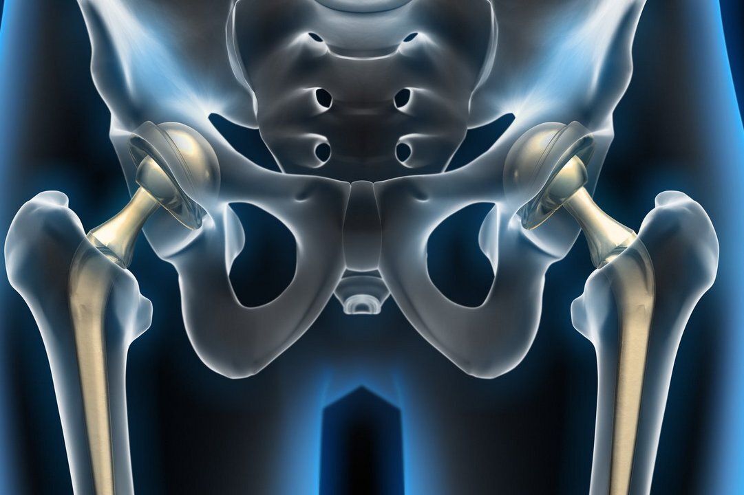 Эндопротез тазобедренного сустава - срок службы