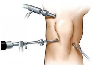 Операция на коленном суставе



