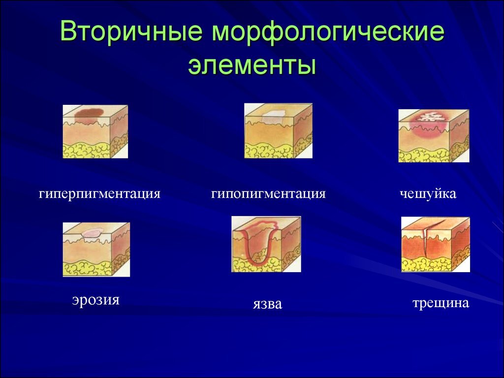 Первичные элементы сыпи фото Основные симптомы и синдромы аллергических и кожных заболеваний Антон Няшин Дзен