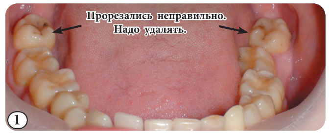 На фото 1 нижнего зубного ряда 8-е зубы (черные стрелки) необходимо удалить по причине их неправильного прорезывания. 
