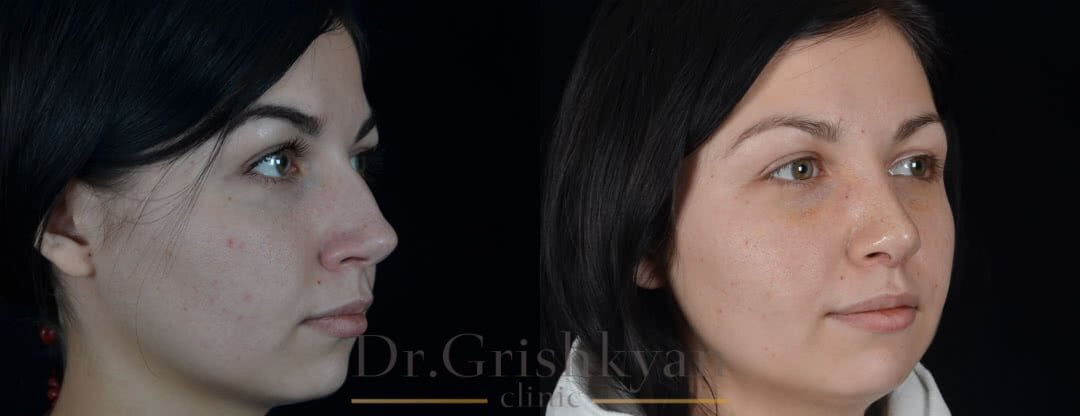 Повторная ринопластика фото до и после. Фото с сайта Д.Р. Гришкяна. Имеются противопоказания, требуется консультация специалиста