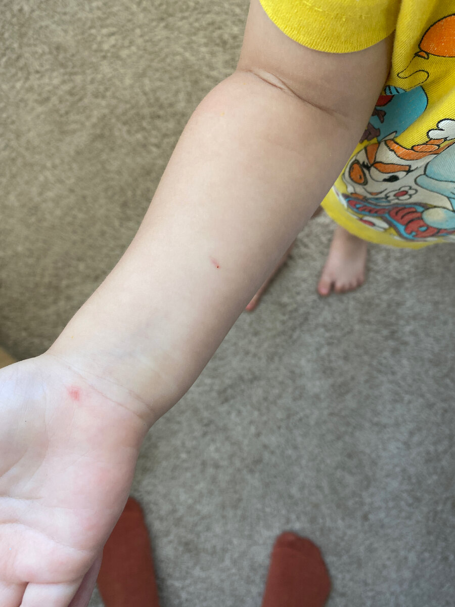 Первый день пробы манту