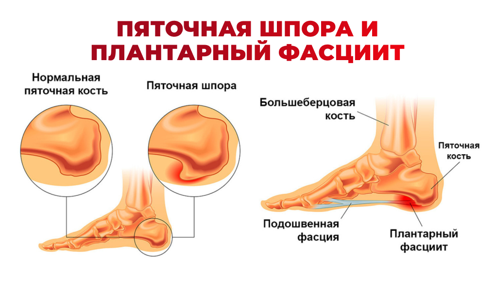 Пяточная шпора