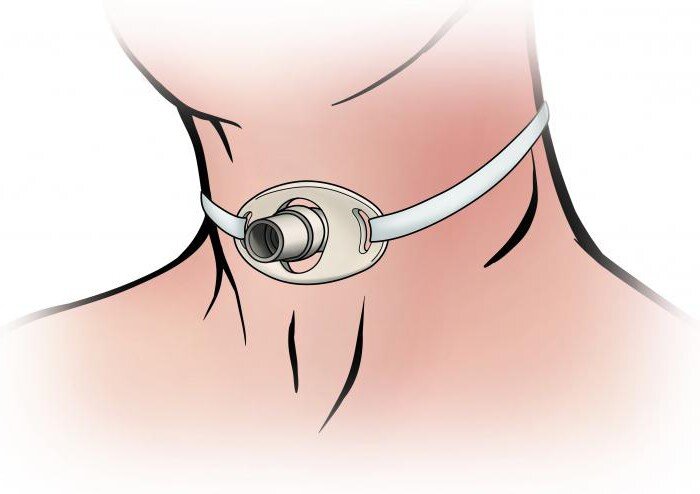 Так выглядит трахеостома.