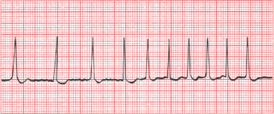 Фибрилляция предсердий на ЭКГ
