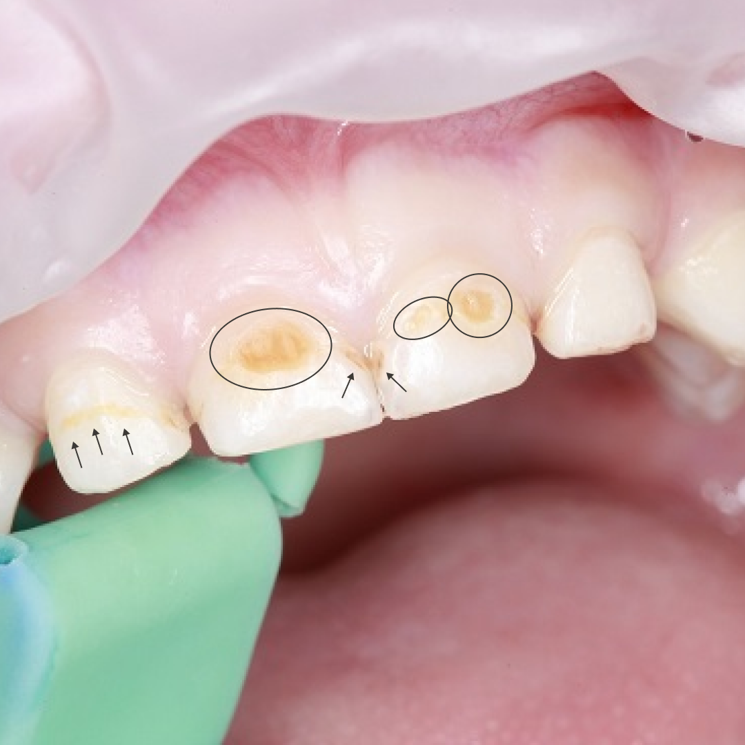 "Бутылочный" кариес