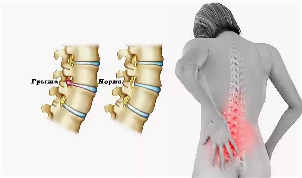 Лечение грыжи позвоночника | Все о лечении суставов и позвоночника |  ГлавМедЦентр | Дзен