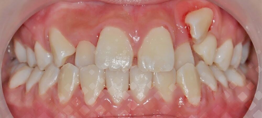 Дистопированный зуб – это какой? | Стоматология Smile-at-Once | Дзен
