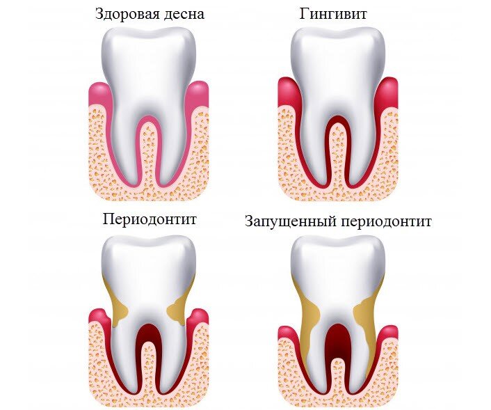 Что делать, если опухла десна возле зуба?