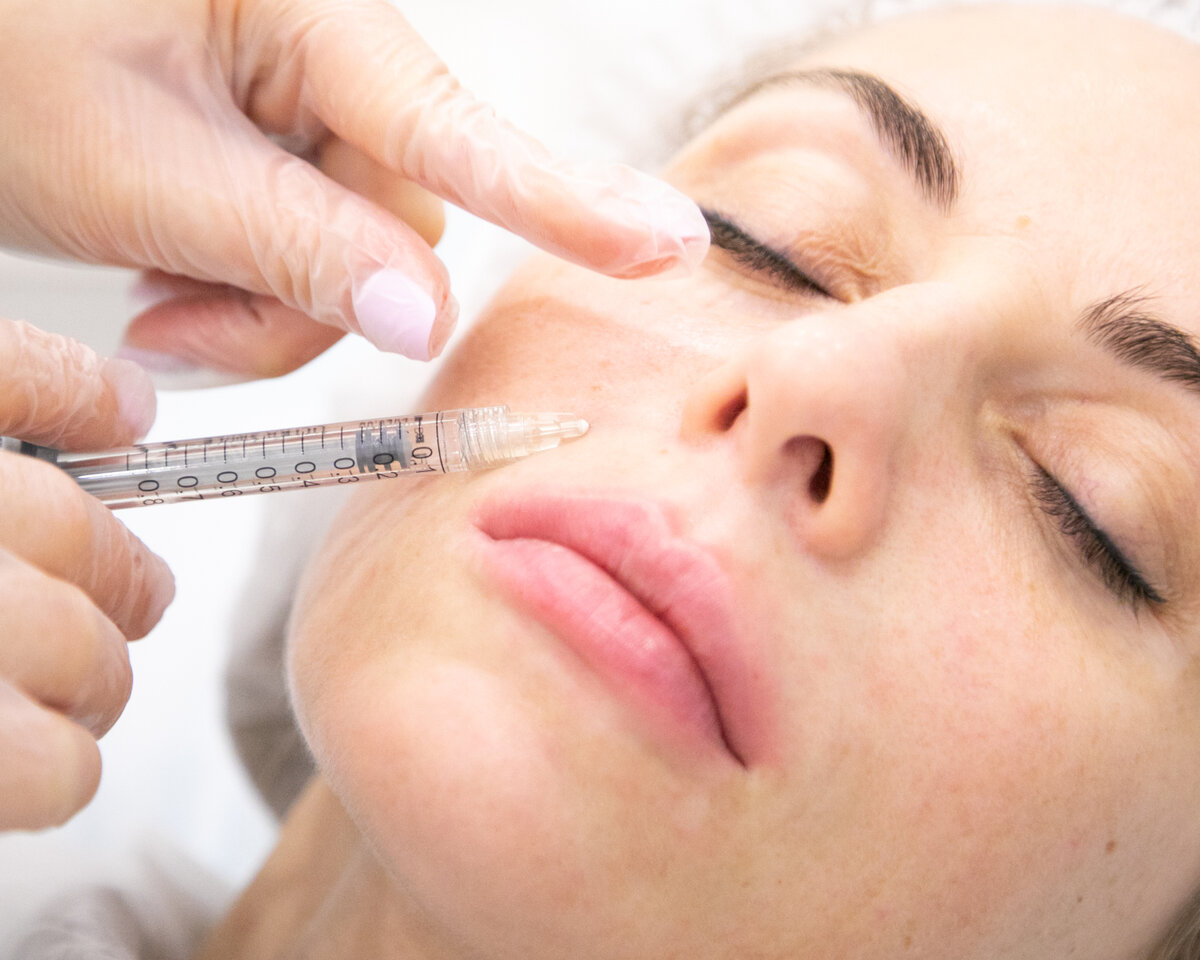 оррекция носогубных складок препаратом Juvederm