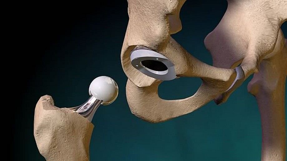 Операция сустав шейки бедра. Эндопротезирование тазобедренного сустава DEPUY. Эндопротез тазобедренный Титан керамика. Эндопротезирование тазобедренного сустава керамика. Implantcast тазобедренный сустав.