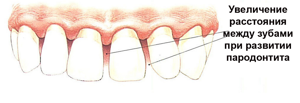 Какое расстояние между зубами. Перегородка между зубами. Разъезжаются передние зубы.