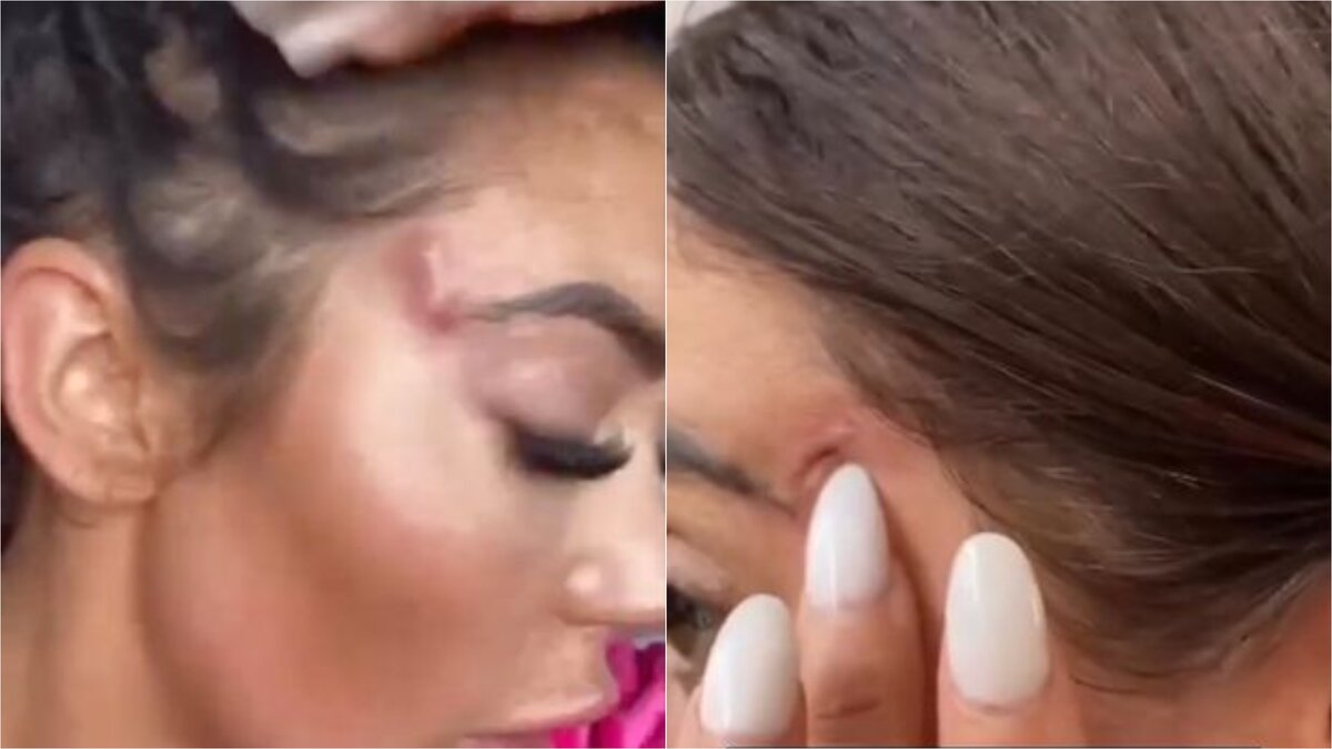    Хлоя Ферри показала шрамы на лице Соцсети Хлои Ферри