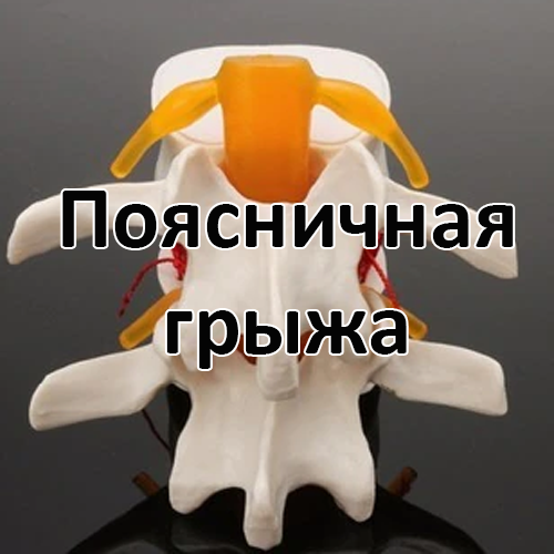 Как проявляется поясничная грыжа и как с ее вылечить тут