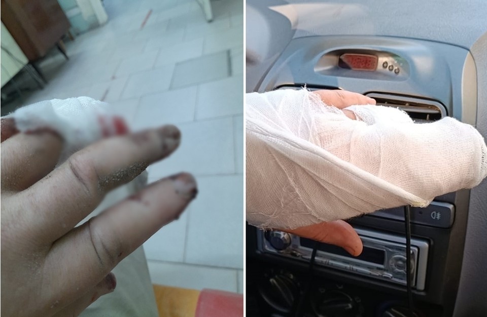     Медики зашили Андрею поврежденный палец, а на одну руку наложили гипс. Фото предоставлено Андреем Зуйкиным.