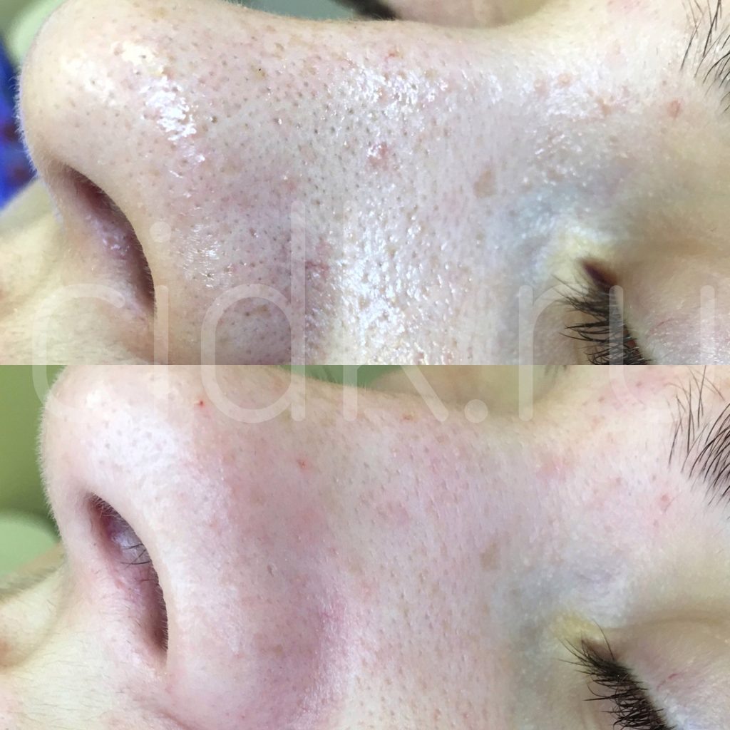 Результат чистки HydraFacial