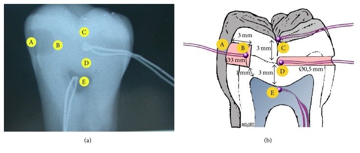 Рентгеновский снимок зуба, показывающий положение термопары + схематическое изображение.