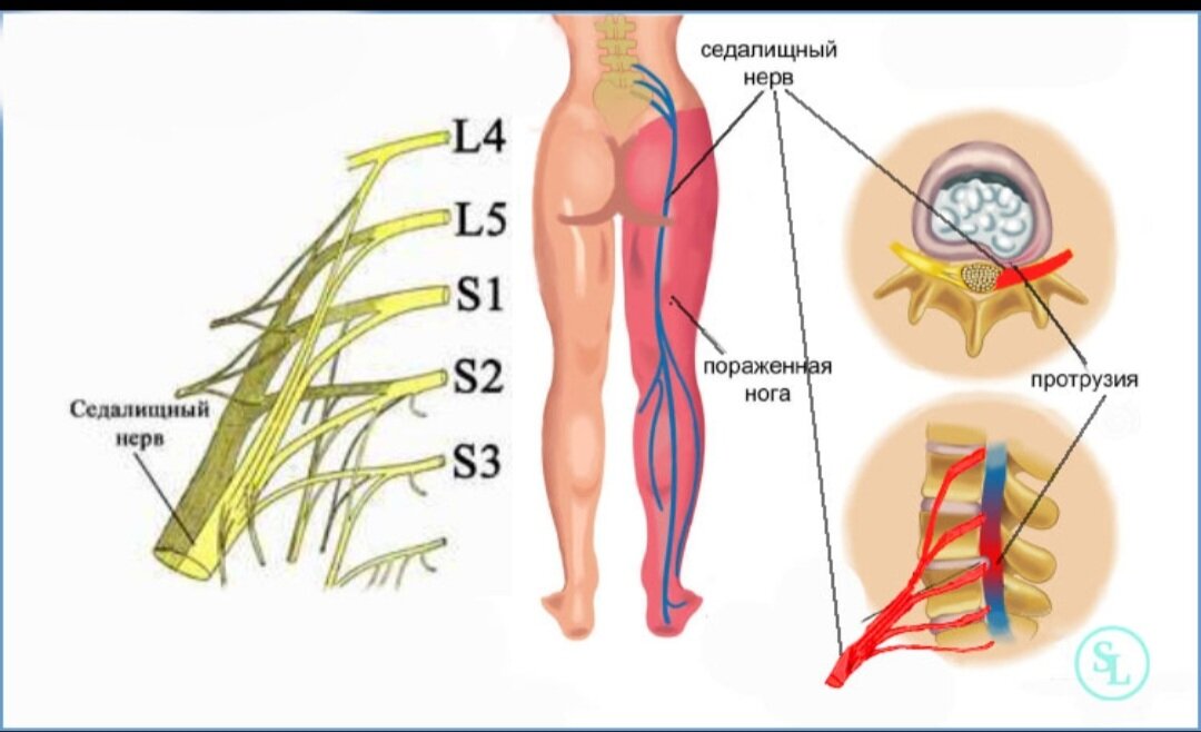 Как идет седалищный нерв фото