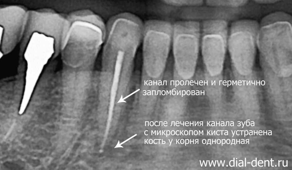 Лечение кисты у корня зуба - микроскоп поможет спасти зуб | Стоматология  Диал-Дент | Дзен