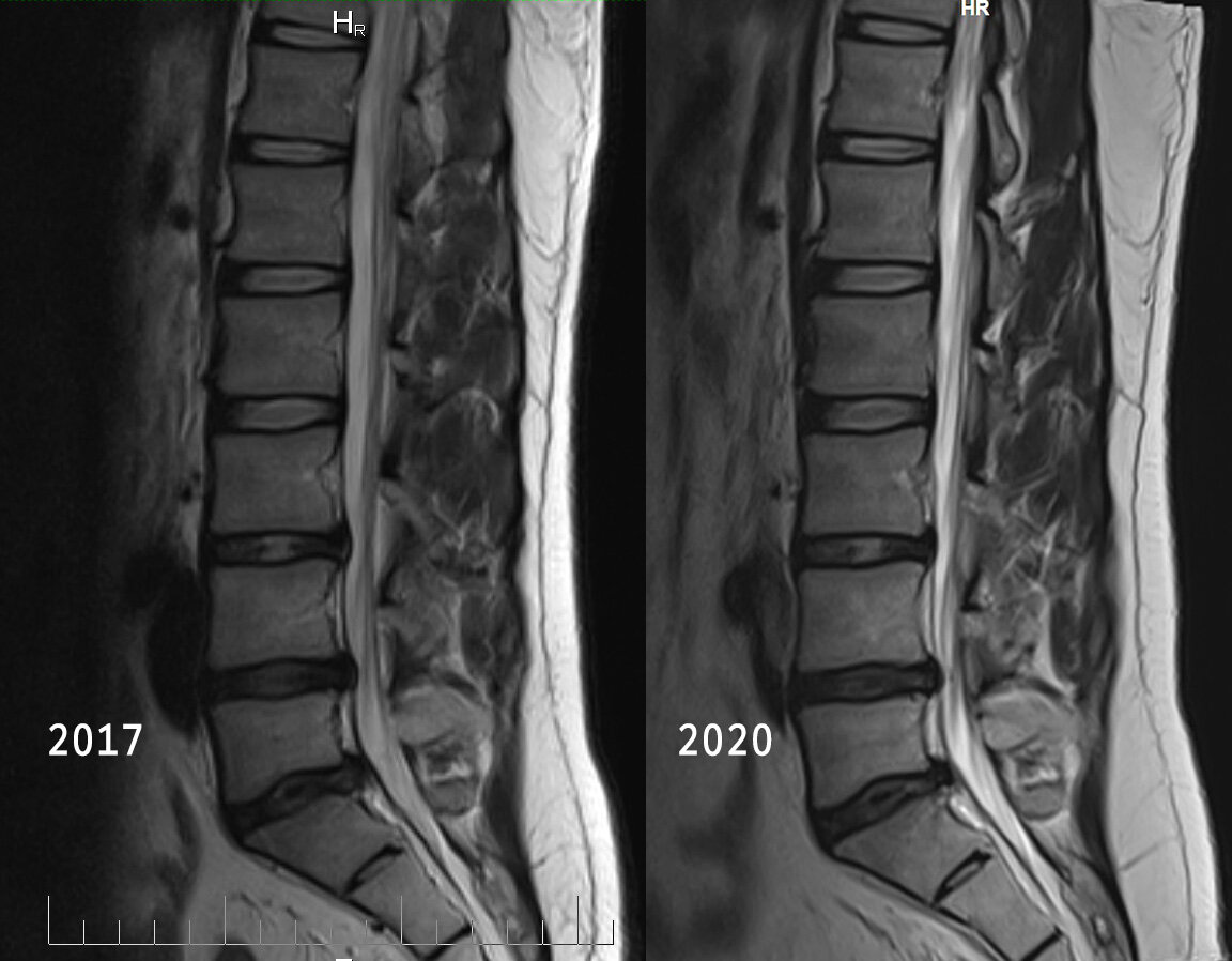 Видно что в 2017 году грыжи были больше, но вес тогда у меня был 84кг и спортивная активность куда выше чем в 2020 году, где вновь поправился до 110 примерно.