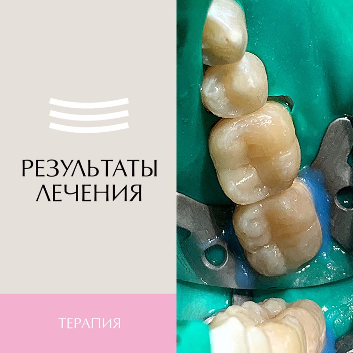 Лечение кариеса зубов в Сочи. Студия улыбок в Сочи