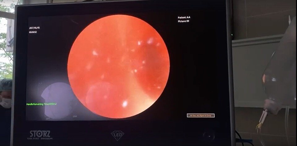     Пациент долго мучился с камнями в почках, пока не попал к рязанским врачам. А в федеральных центрах не смогли.