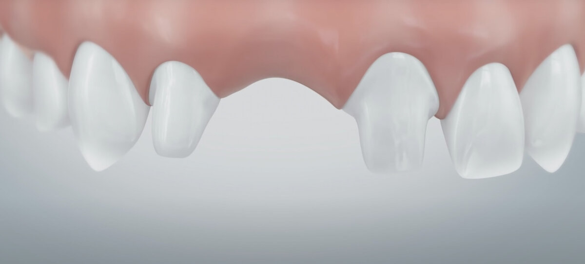 Подготовка зубов к установке мостовидного протеза: обточка эмали и дентина